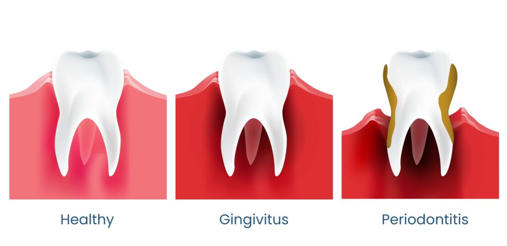 Periodontitis e1769035889491