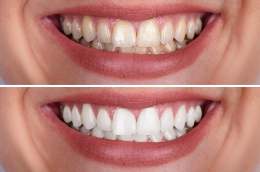 Before and after teeth whitening