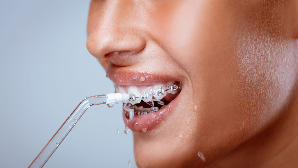 closeup cleaning braces with irrigator 849403312